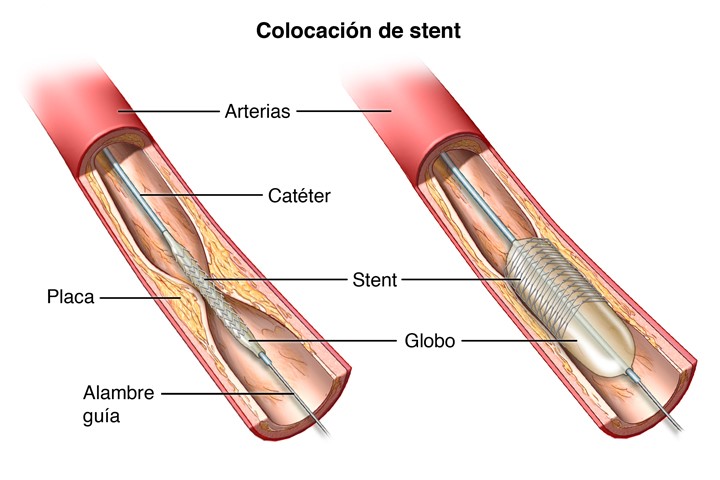 colocacion-de-stent