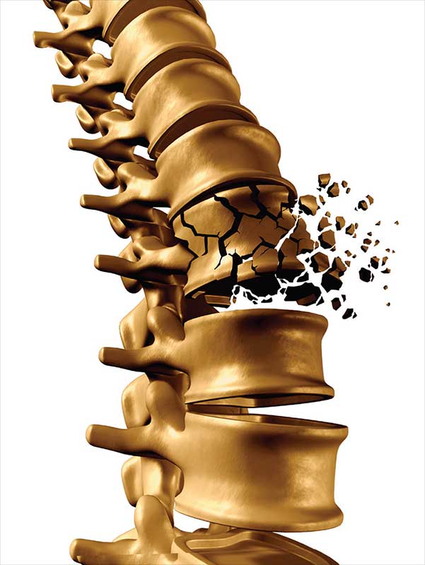 fracturas-vertebrales-por-osteoporosis
