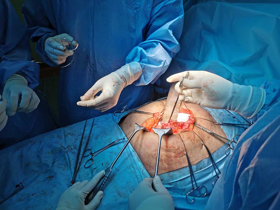 robotic-radical-prostatectomy-with-concomitant-repair-of-inguinal-hernia